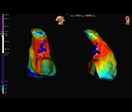 Mapeo Electroanatomico